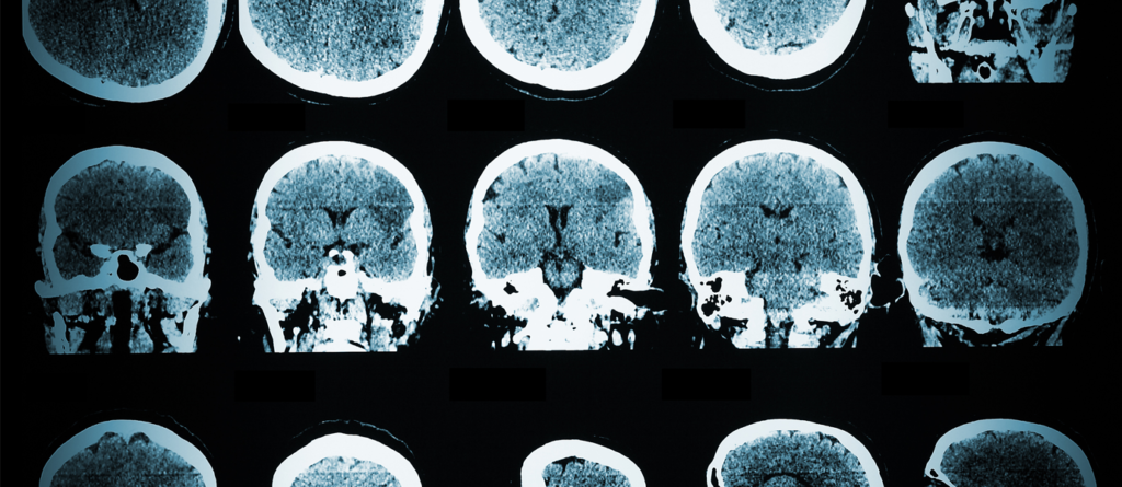 brain-cancer